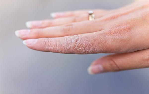 13 اقدام ساده و کاربردی برای درمان خشکی دست
